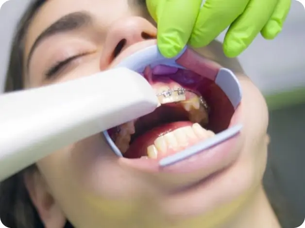 braces